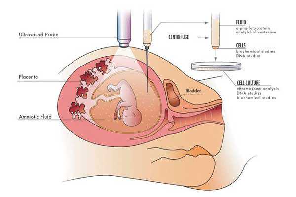去香港验血是否怀孕要多少钱,宫腔积液如何影响辅助生殖技术中助孕过程？